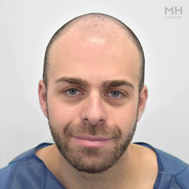 Before Hair transplant