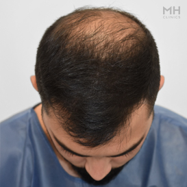 Before Hair transplant