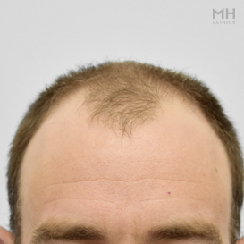 Before Hair Transplant