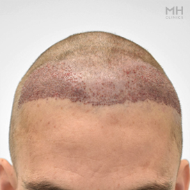 After Hair transplant