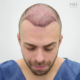 After Hair transplant