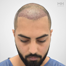 After Hair transplant