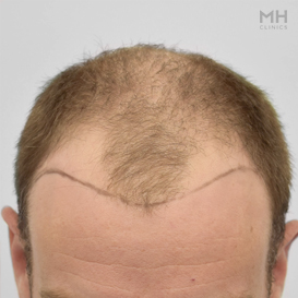 Before Hair Transplant