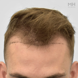 Before Hair transplant