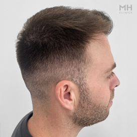 After Hair transplant