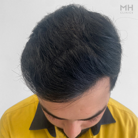 After Hair transplant