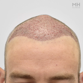 After Hair Transplant