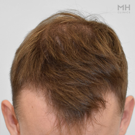 Before Hair Transplant