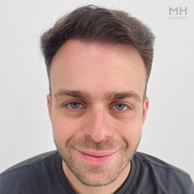 After Hair transplant