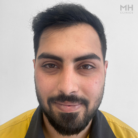 After Hair transplant