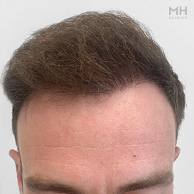 After Hair Transplant