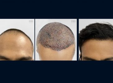 Why Hair Loss Is About More Than Hair (1)