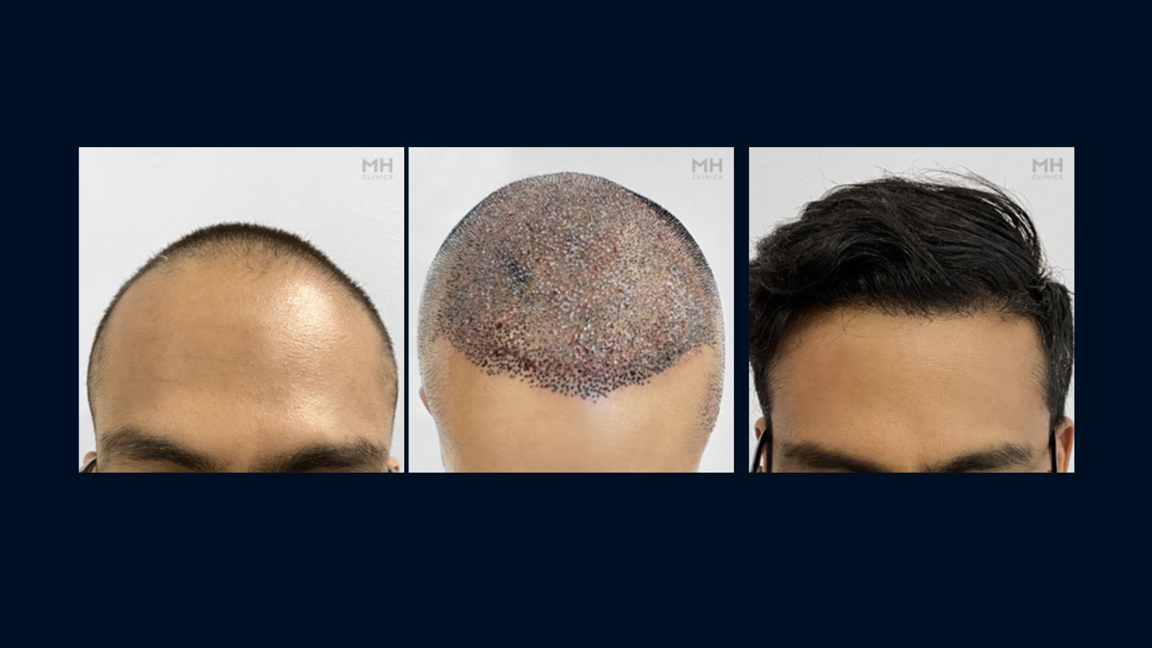 Why Hair Loss Is About More Than Hair (1)